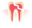 ❷ 外傷などによる歯の破折