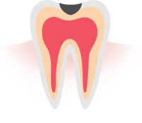 3 C2（歯の中まで進んだ虫歯）