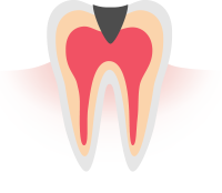 4 C3（神経まで進んだ虫歯）