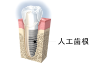 1） 人工歯根