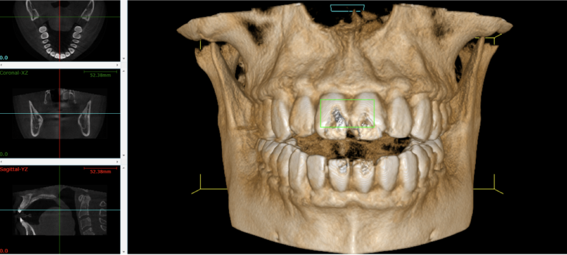 歯科用CT2つの特徴