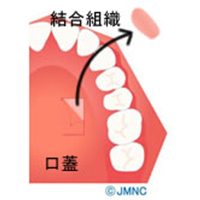 3） アバットメント