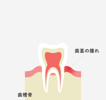 歯周病治療