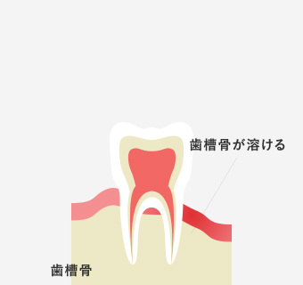 歯周病治療