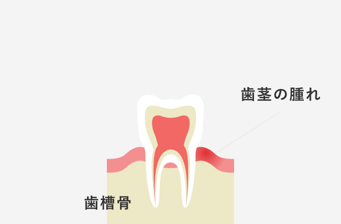 歯周病治療