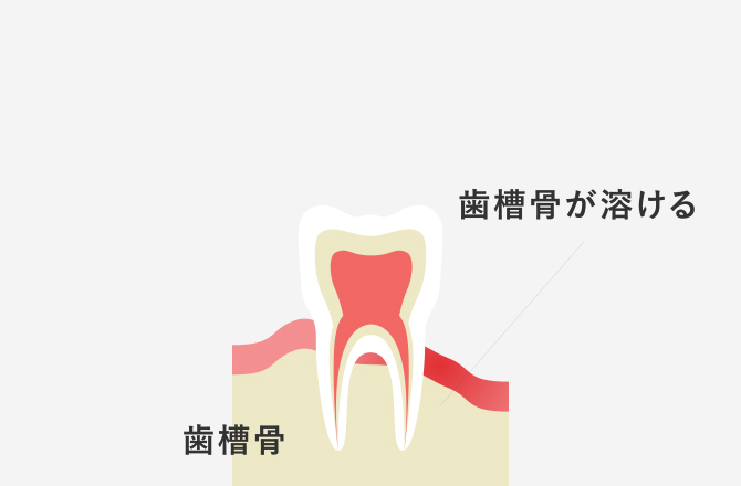 歯周病治療