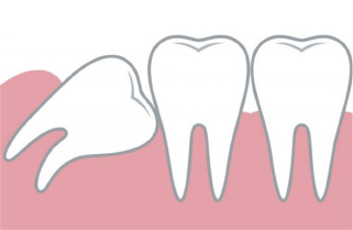 2） 歯並びに影響がでることがある